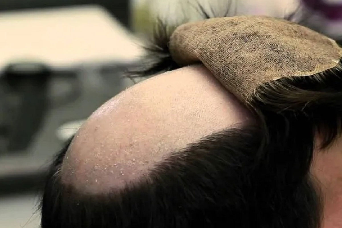 Hair Patch 